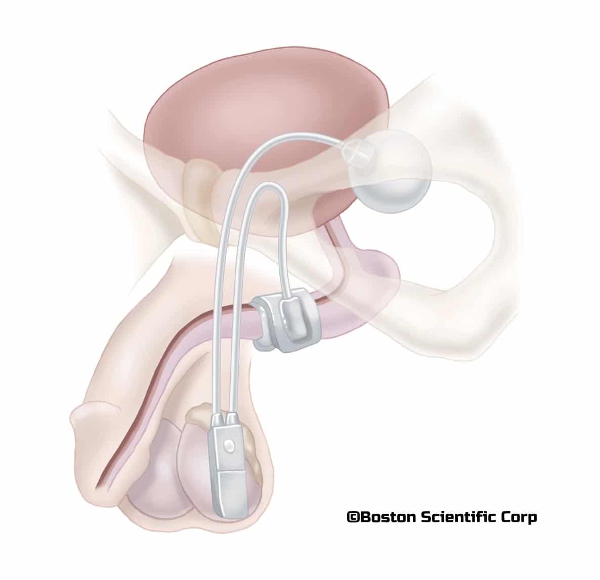 Comment Traiter L Incontinence Masculine Operation Schema Du Corps L'Incontinence Urinaire chez l'Homme après une Prostatectomie