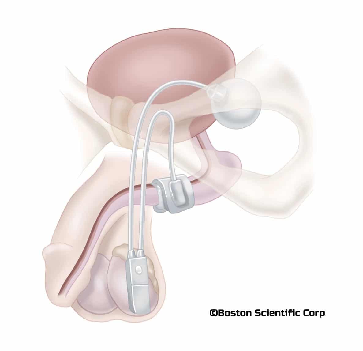 Comprendre l'incontinence urinaire masculine : causes et solution