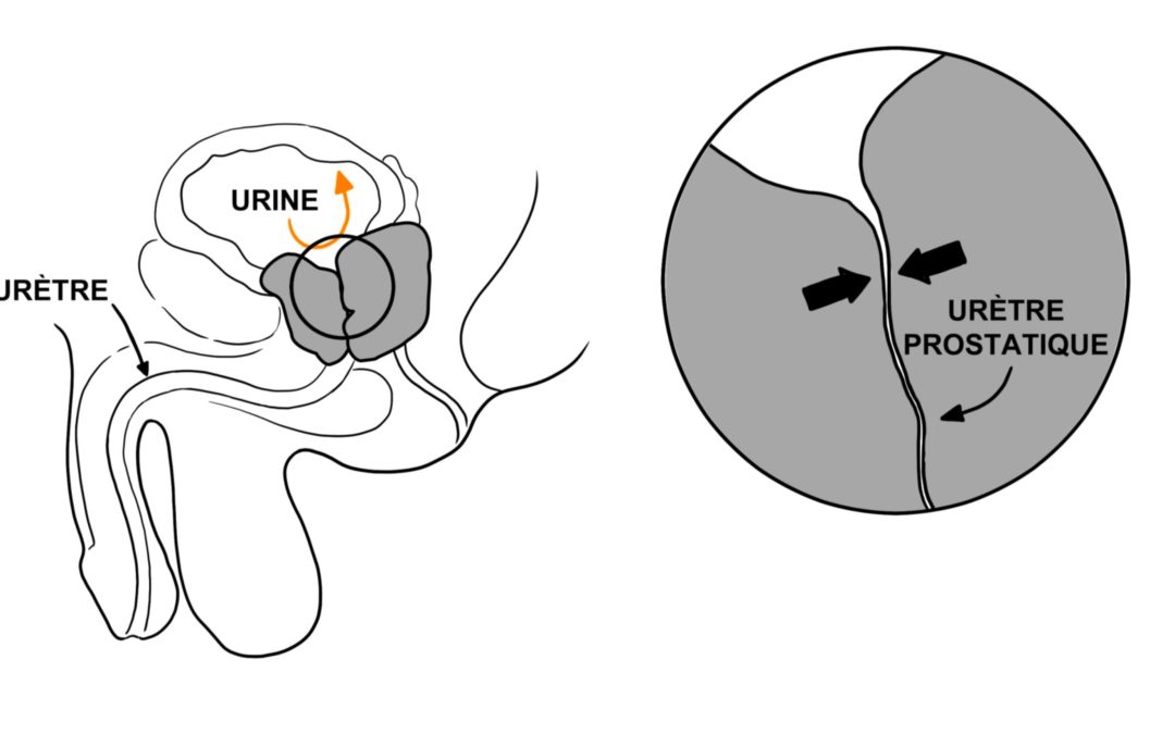 La rétention aigüe d’urine ou blocage urinaire : une urgence urologique.