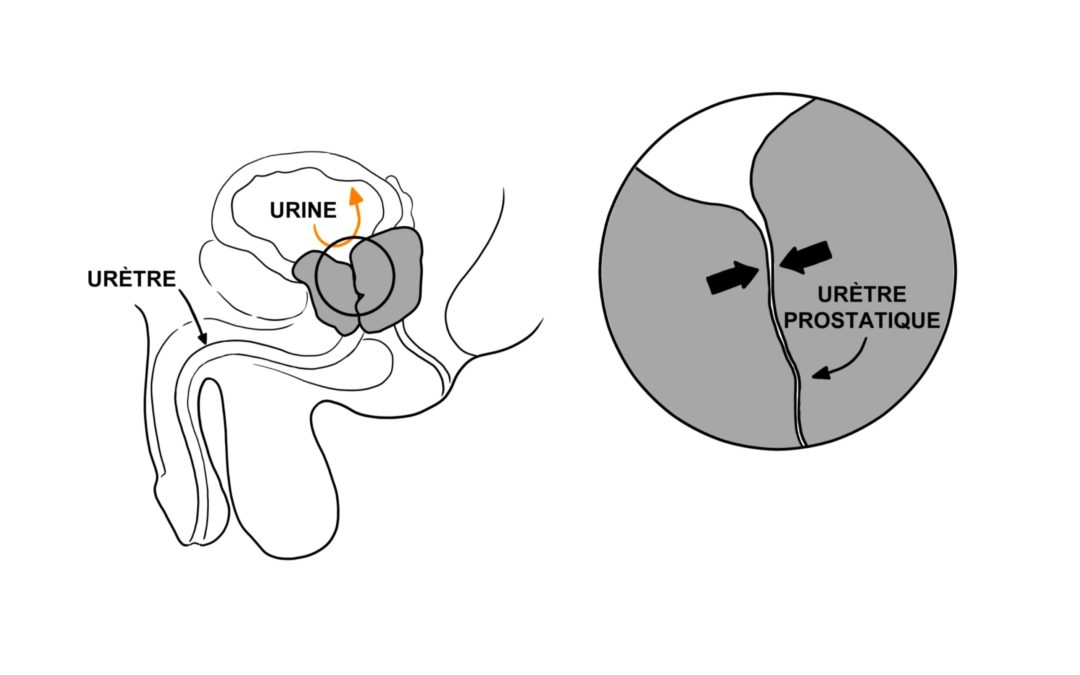 hypertrophie de la prostate et difficulté à uriner