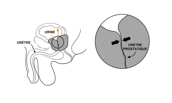 hypertrophie de la prostate et difficulté à uriner