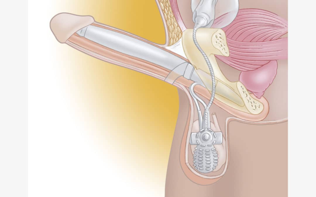 Tout ce que vous avez toujours voulu savoir sur l’implant pénien gonflable.