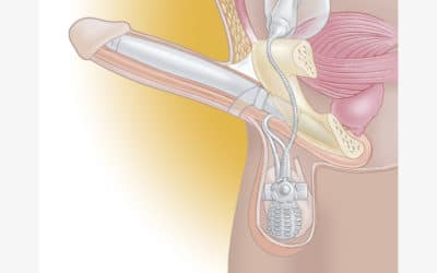 Tout ce que vous avez toujours voulu savoir sur l’implant pénien gonflable.