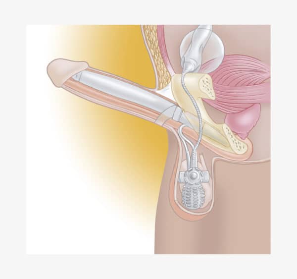 prothèse pénienne gonflable AMS 700