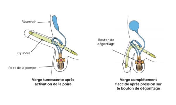 fonctionnement d'une prothèse pénienne gonflable.