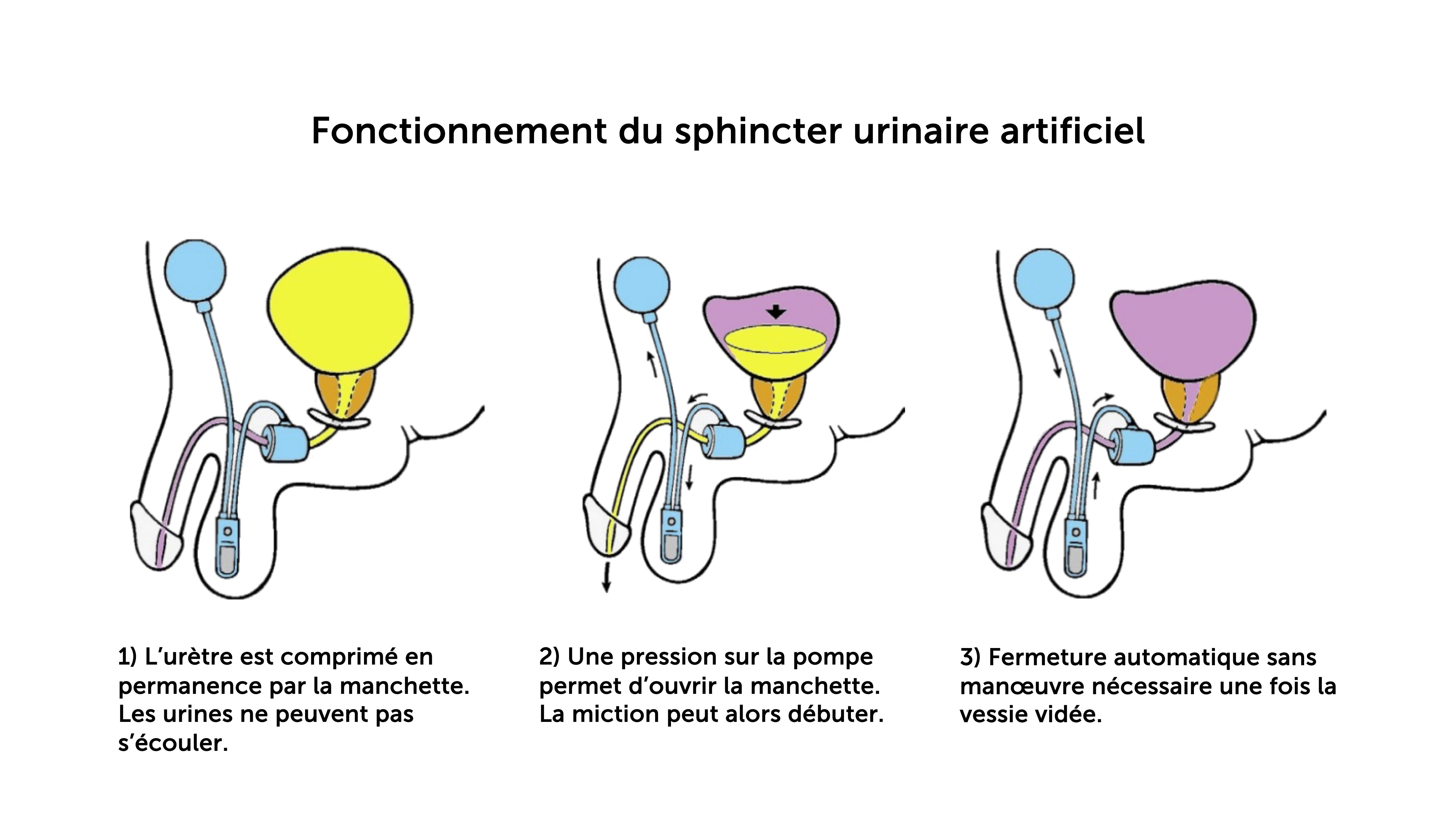 L'incontinence, aussi un problème d'homme?