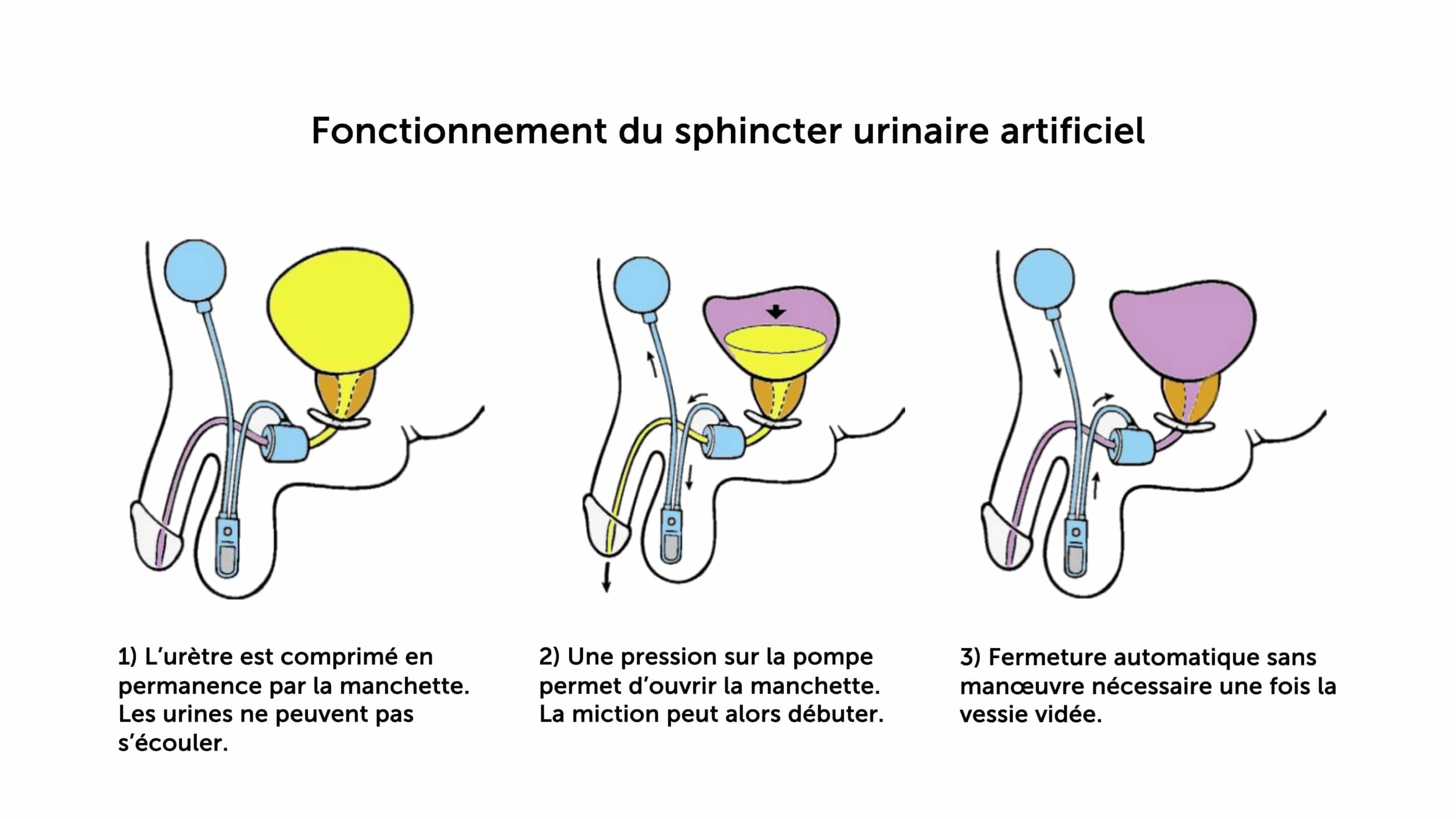 3.-Fonctionnement-dun-sphincter-artificiel-urinaire-AMS-800-final
