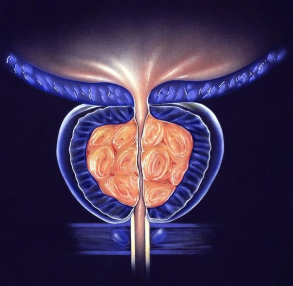 hypertrophie prostatique - adénome de la prostate