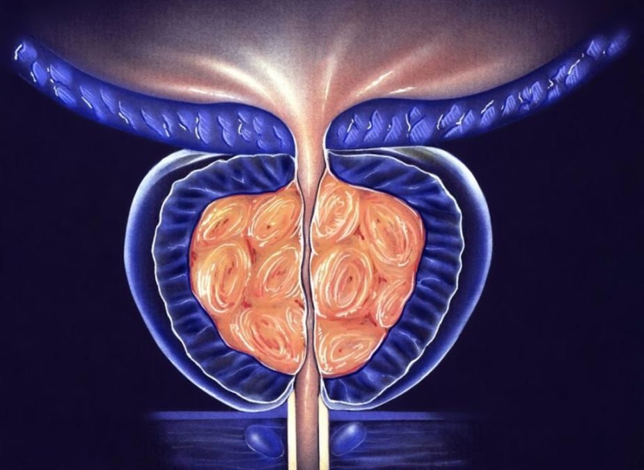 prostate nodule ultrasound