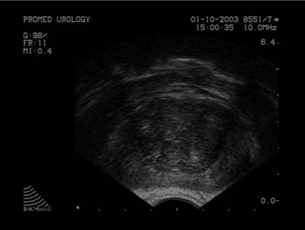 échographie de la prostate