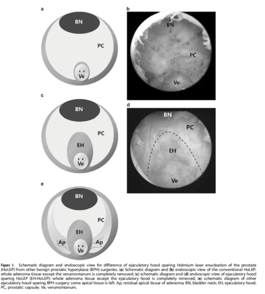 adénome de la prostate (HoLEP): préservation de l'éjaculation