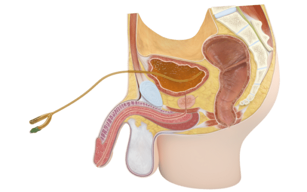 catheter sus-pubien et rétention urinaire