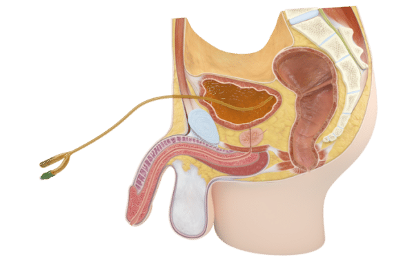 La Rétention Urinaire, une Urgence Chirurgical de la Prostate