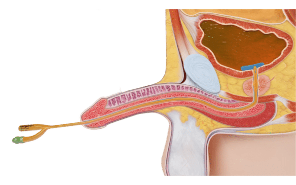 La Rétention Urinaire, une Urgence Chirurgical de la Prostate