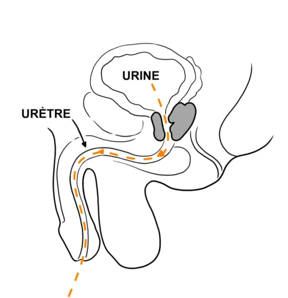 La Rétention Urinaire, une Urgence Chirurgical de la Prostate