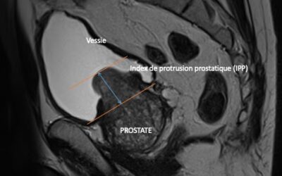 Retentissement du lobe médian sur l’hypertrophie de la prostate.