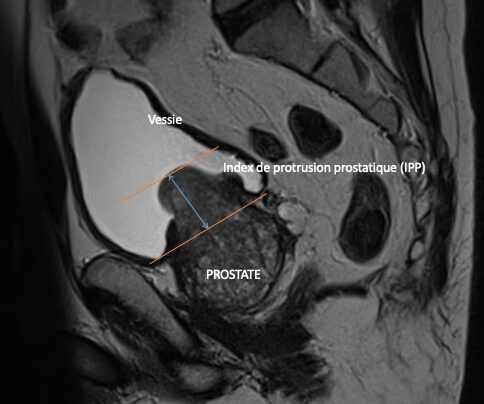 Index protrusion prostatique (IPP) et blocage urinaire