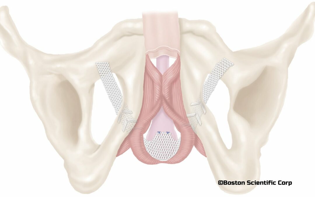 Schéma de la mise en place d'un filet pour éviter le déplacement des muscles autour de la prostate