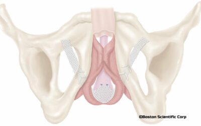 Comprendre l&rsquo;efficacité à long terme de la bandelette Advance XP pour l&rsquo;incontinence urinaire post-prostatectomie de faible importance ou modérée.