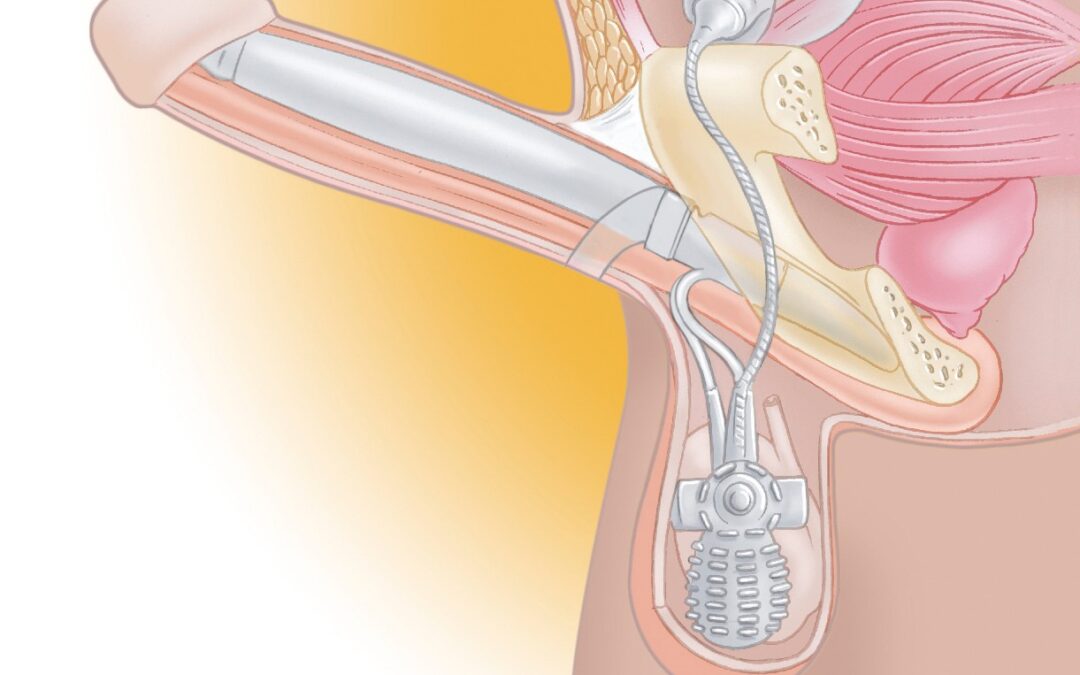 Histoire et Évolution des Implants Péniens : histoire de la prothèse gonflable 3 pièces AMS 700 de Boston Scientific