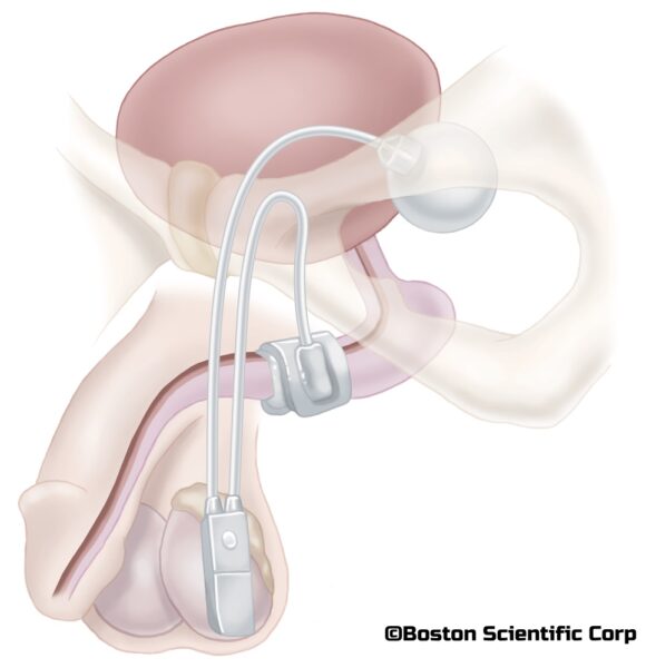 Schéma d'un implant médical installé sur un patient pour traiter l'hyperplasie bénigne de la prostate