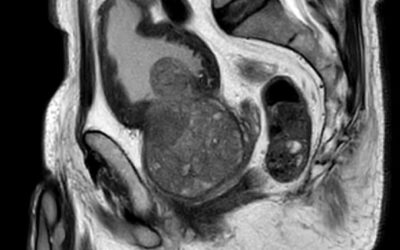 Déroulement et role de l&rsquo;IRM prostatique