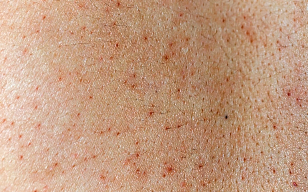 Les vésicules perlées et leurs traitements