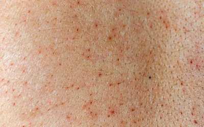 Les vésicules perlées et leurs traitements