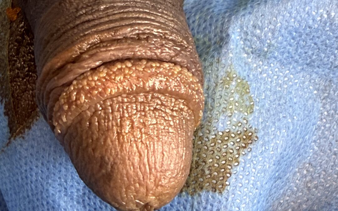 Les vésicules perlées et leurs traitements