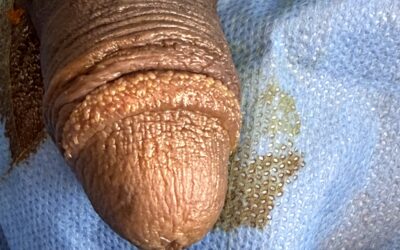 Les vésicules perlées et leurs traitements