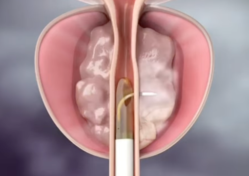 illustration avant et après la pose de l'implant Urolift