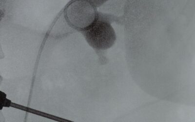 Sonde JJ (Stent Urétéral Double J) : Guide Complet pour les Patients